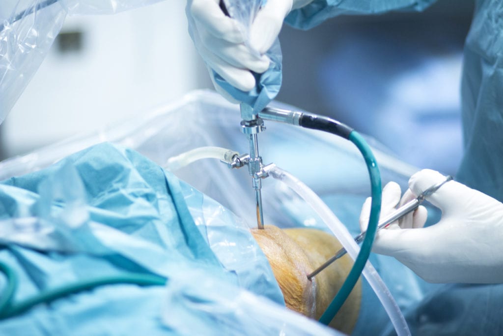 Arthroscopy Benefits