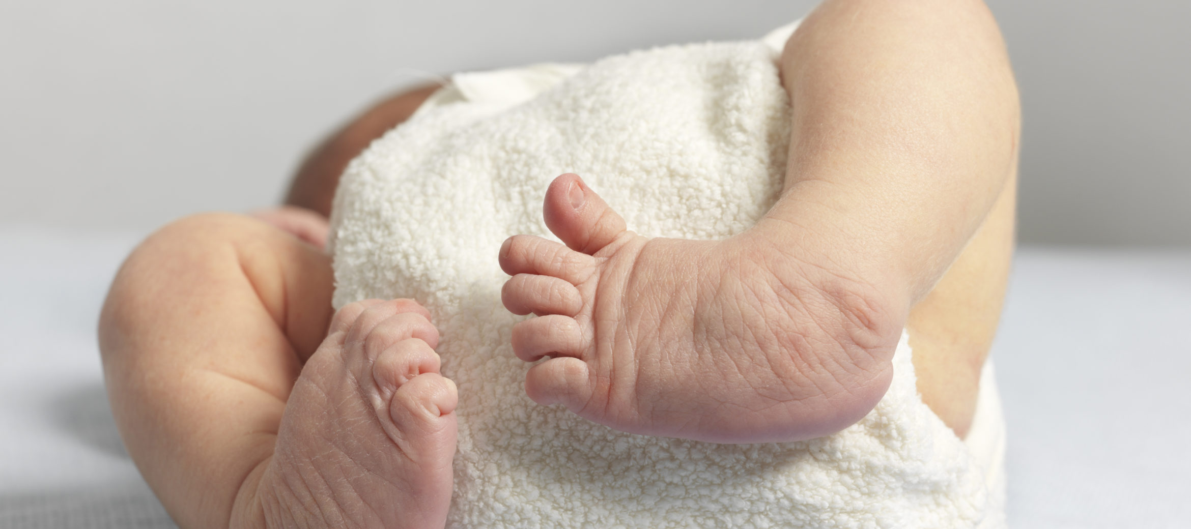Clubfoot Deformity - Front View