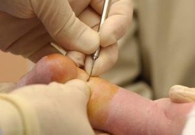 Clubfoot Deformity - Ankle View