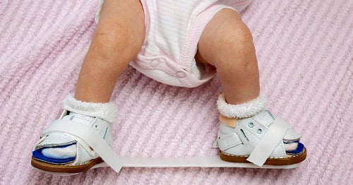 Clubfoot Treatment - Corrected Ankle