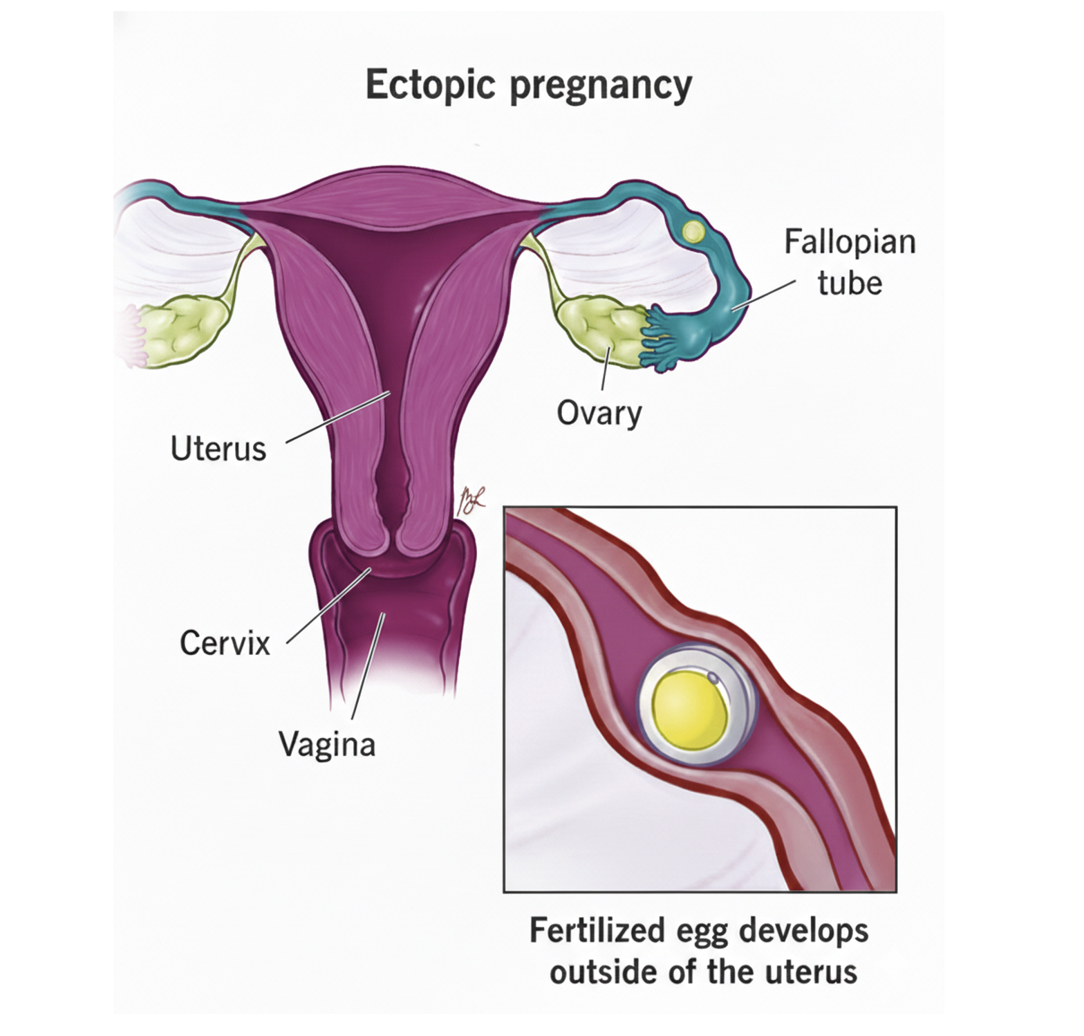 Early Signs and Symptoms of Ectopic Pregnancy