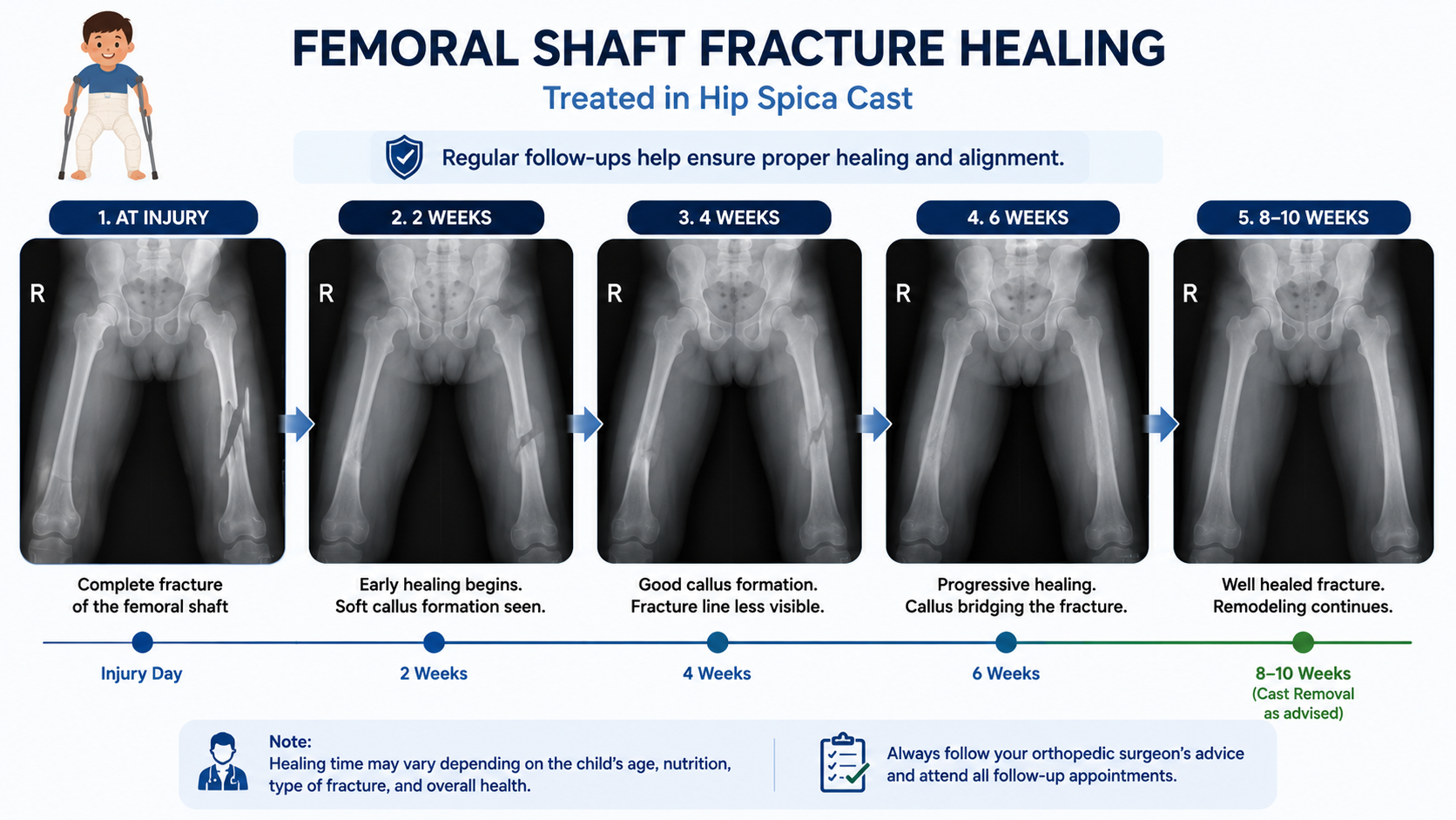 When surgery is recommended for femur fracture in children