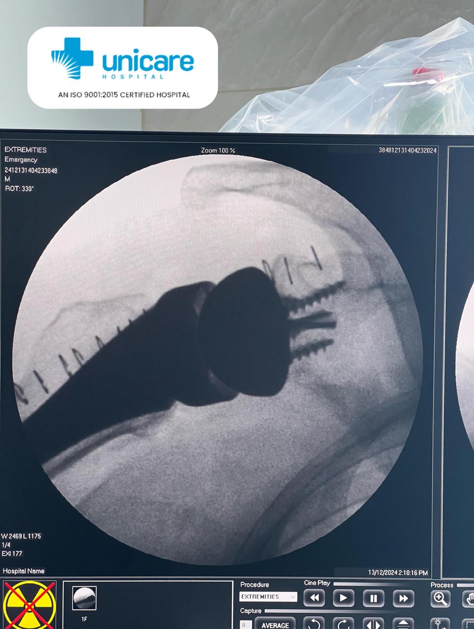 Reverse Shoulder Replacement