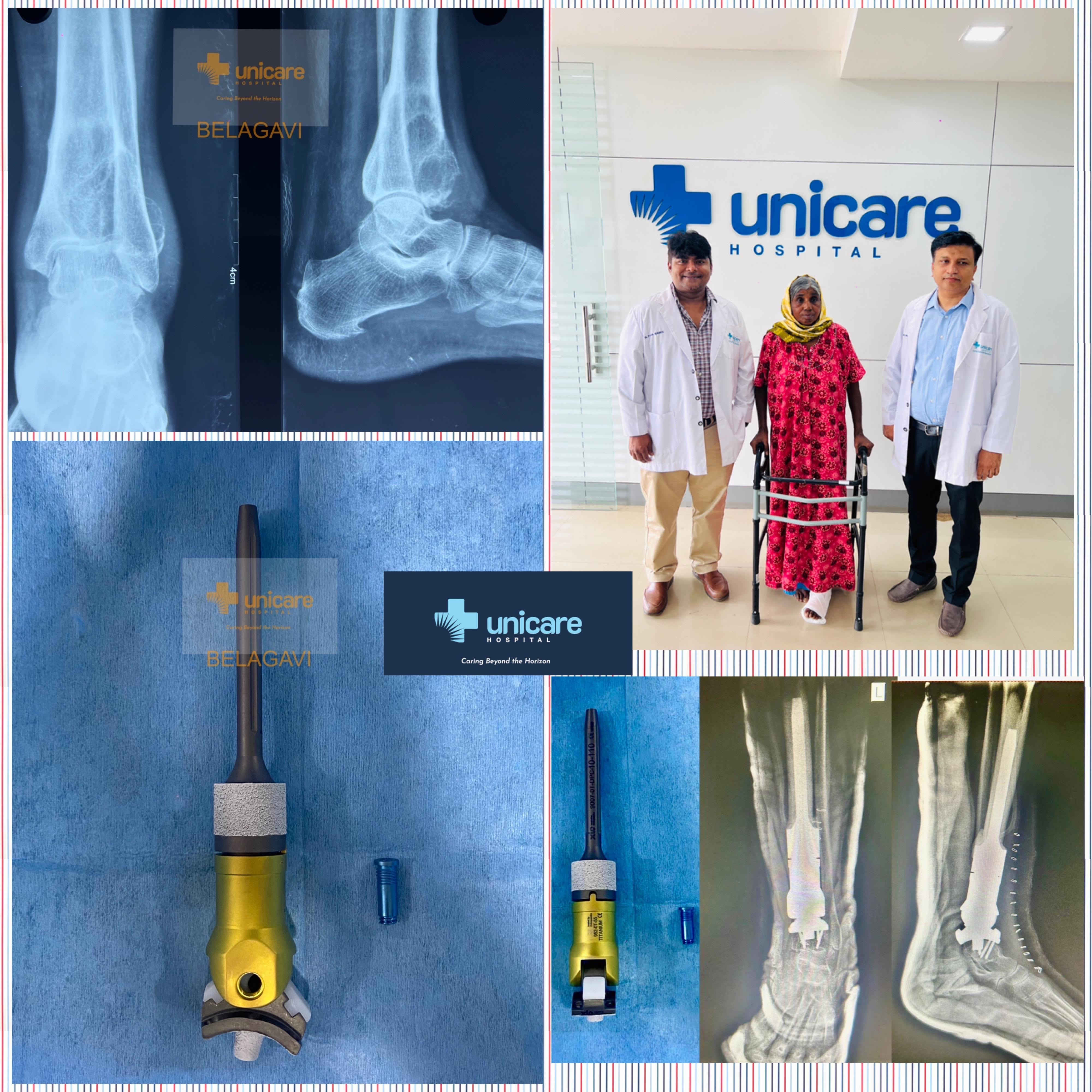Limb-Salvage Surgery